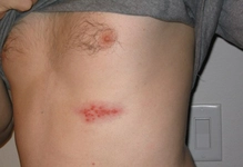 Zona Hastalığı Nedir? Zona Hastalığı Nedir?