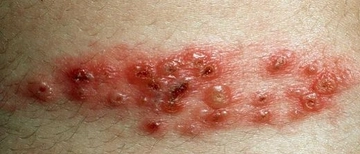 Zona Hastalığı Zona Hastalığı